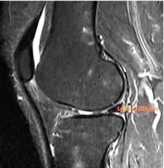 Coronal knee MRI at baseline from supplied study material