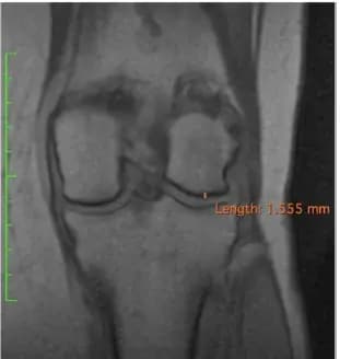 Coronal knee MRI at follow-up from supplied study material