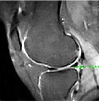 Sagittal knee MRI at baseline from supplied study material