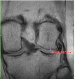 Sagittal knee MRI at follow-up from supplied study material